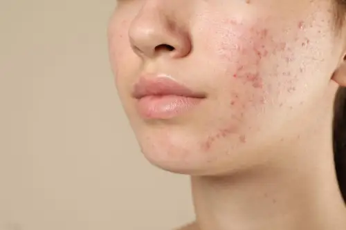 Acne Scars