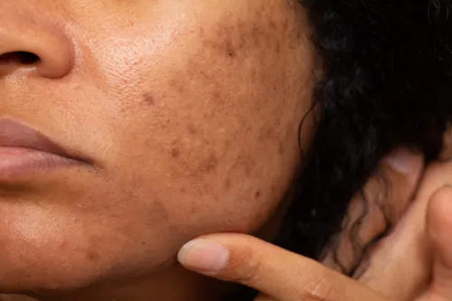 Melasma Laser Treatment